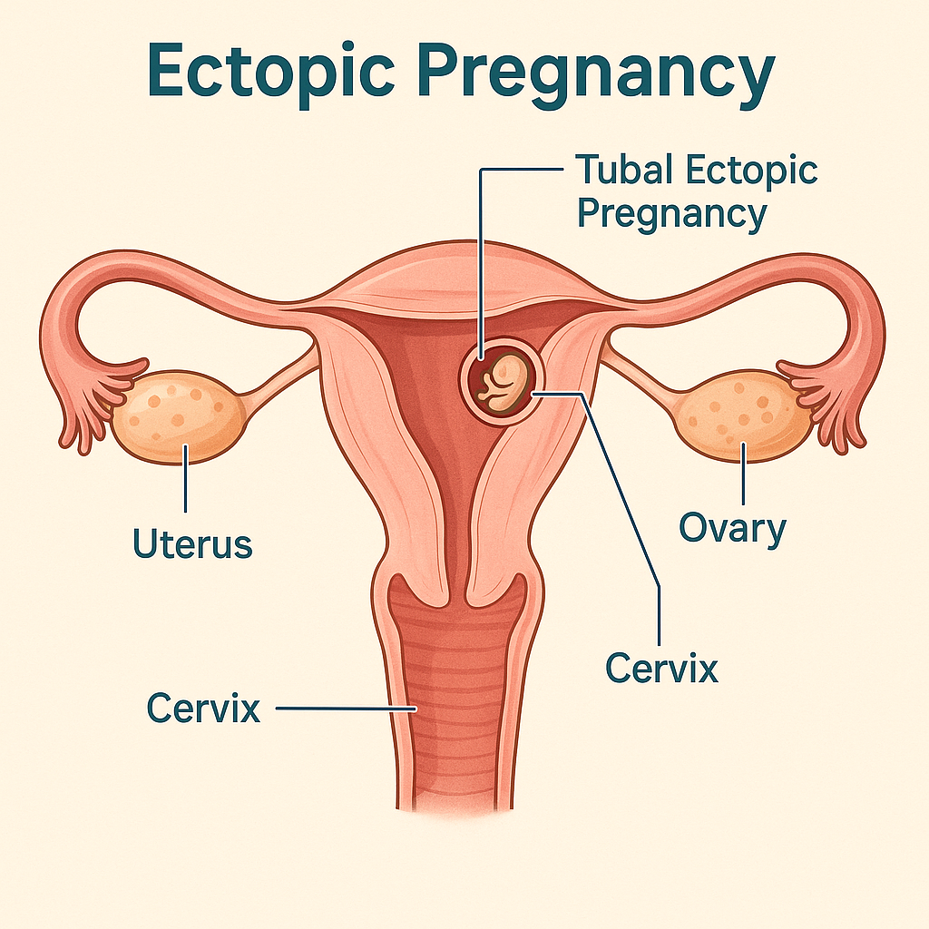 Ectopic Pregnancy: Causes, Symptoms, Diagnosis, Treatment Options & Management Guidelines (2025 Complete Guide) - OBSTETRICS AND GYNAECOLOGY