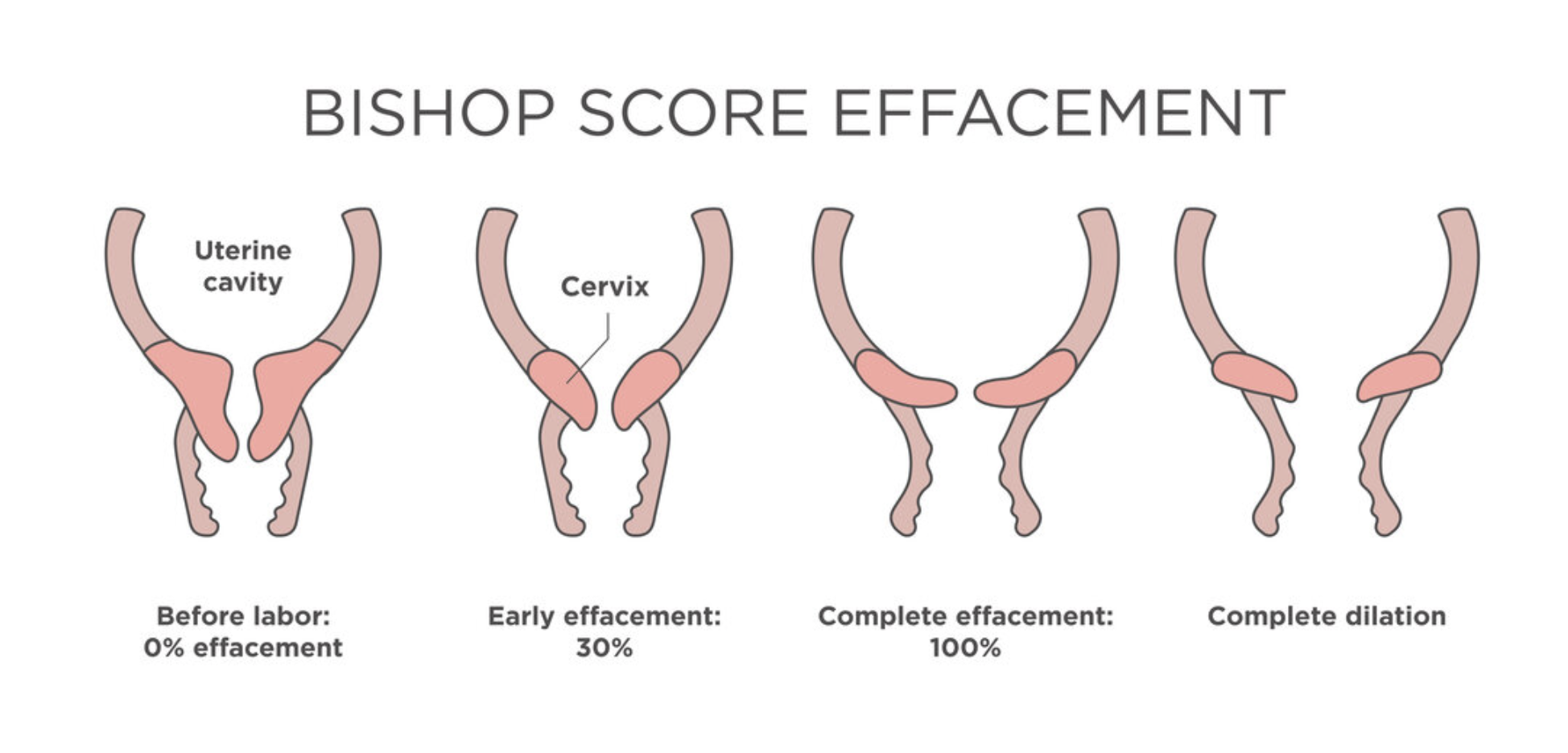 Induction of Labor Indications Methods Contraindications Complications - OBSTETRICS AND GYNAECOLOGY